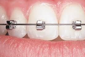 Does Medicaid Cover Orthodontics?